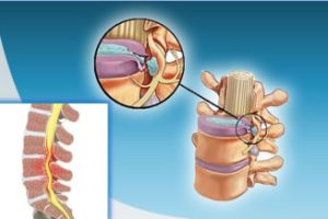 HERNIA DISCAL